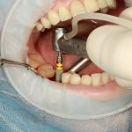„Navigheaza“ printre ofertele de implant dentar si alege-l pe cel potrivit pentru tine!